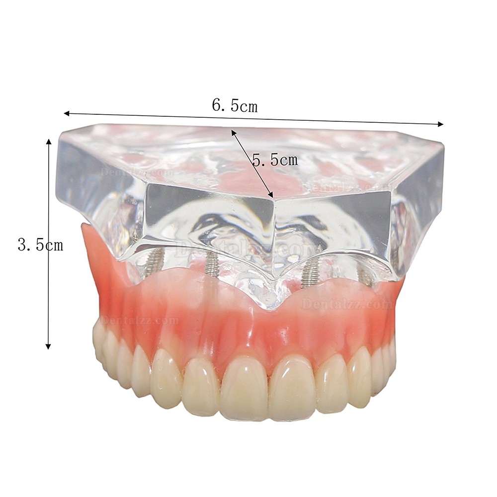 歯科上顎インプラント研究治療説明用歯列モデル模型 4本釘 取り外し可能
