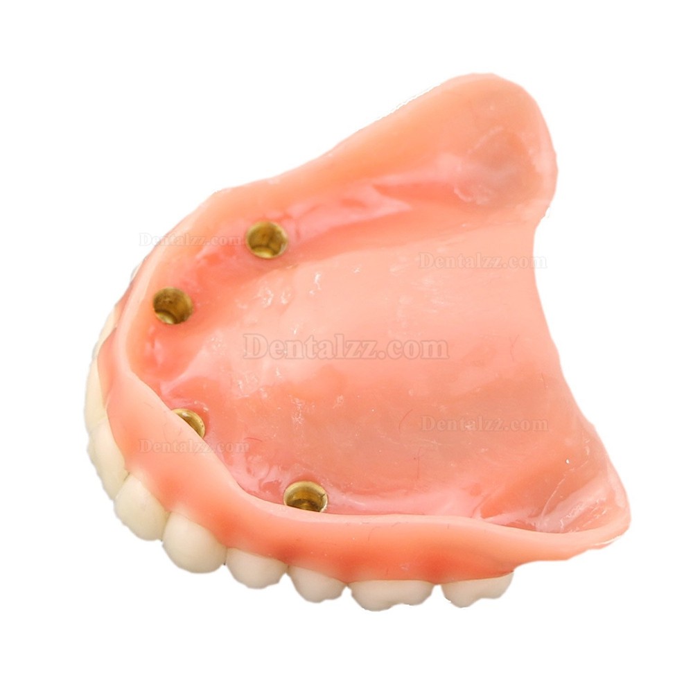 歯科上顎インプラント研究治療説明用歯列モデル模型 4本釘 取り外し可能