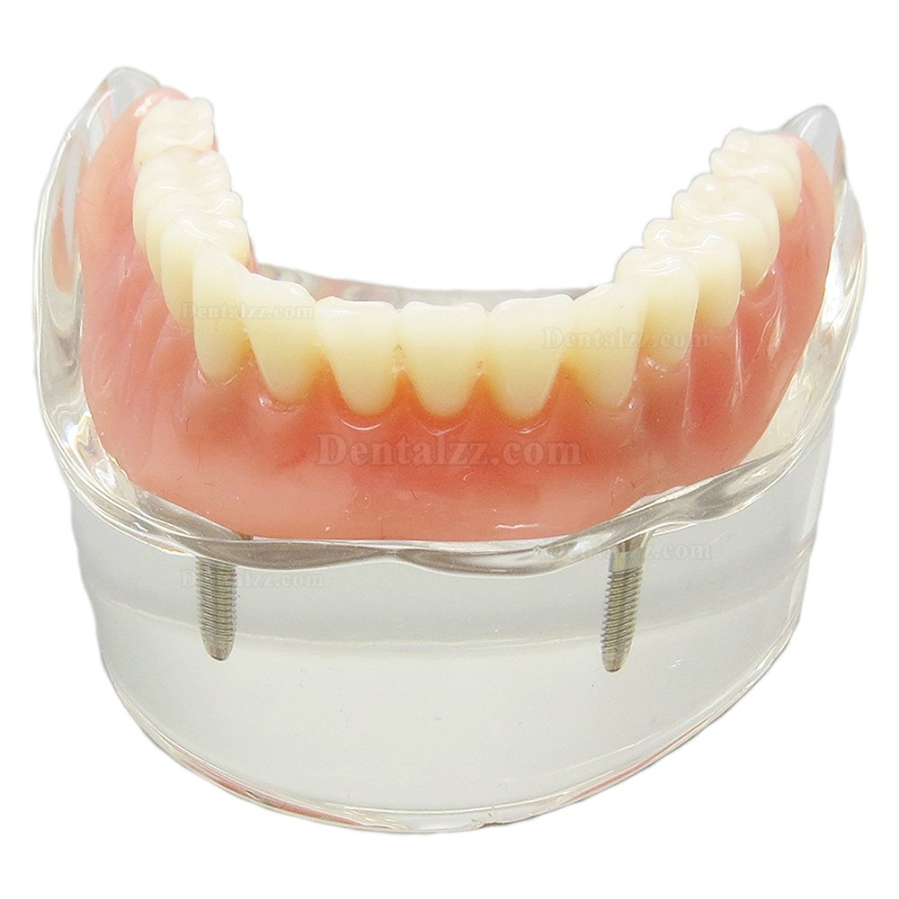 高品質歯科下顎インプラント研究治療説明用歯列模型モデル 取り外し可能 2本釘 透明 クリアベース
