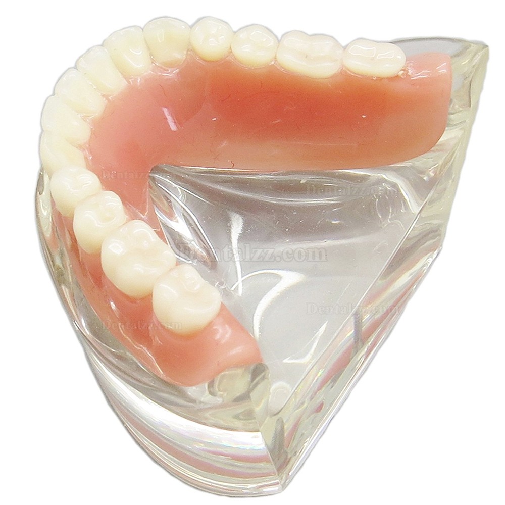 高品質歯科下顎インプラント研究治療説明用歯列模型モデル 取り外し可能 2本釘 透明 クリアベース