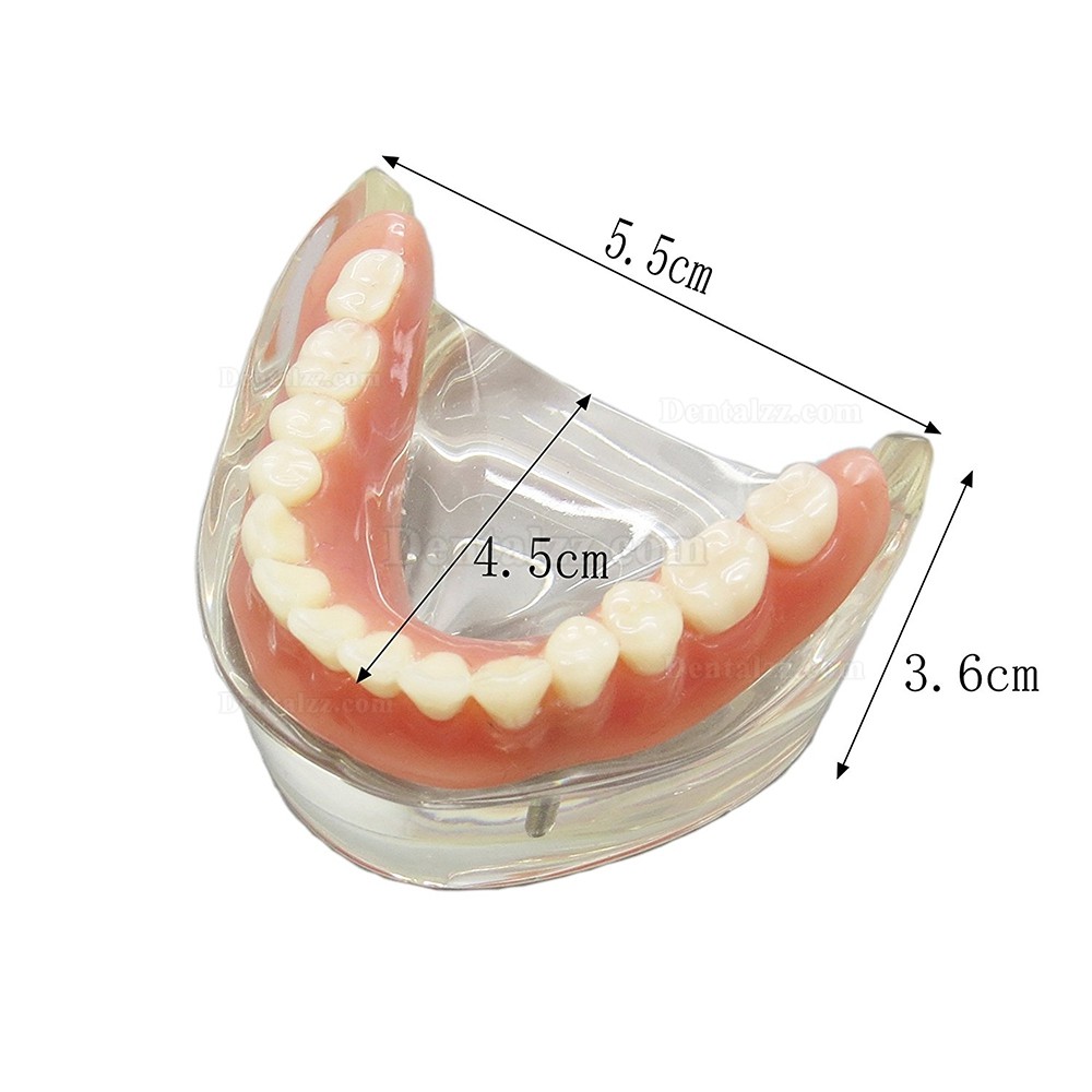 高品質歯科下顎インプラント研究治療説明用歯列模型モデル 取り外し可能 2本釘 透明 クリアベース