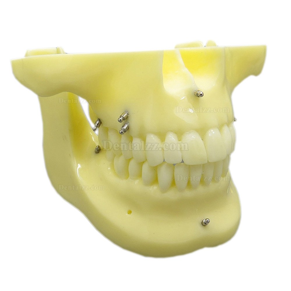 歯科矯正用上下顎歯列模型モデル スクリューアンカー付き 脱着可能 イエローベース