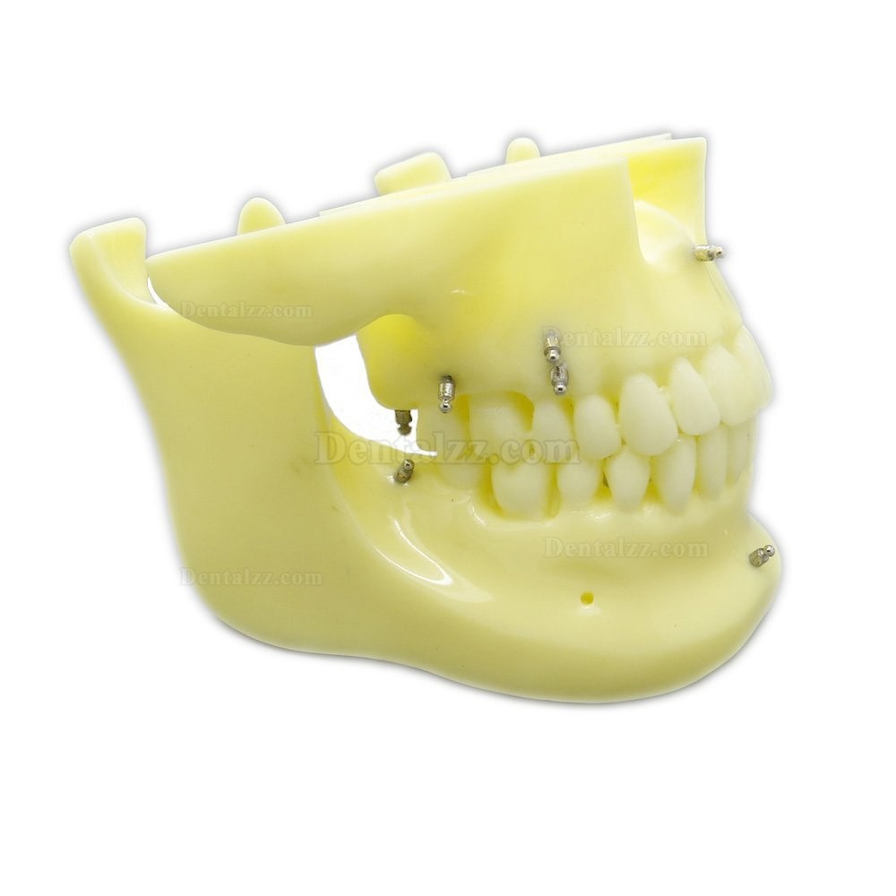 歯科矯正用上下顎歯列模型モデル スクリューアンカー付き 脱着可能 イエローベース