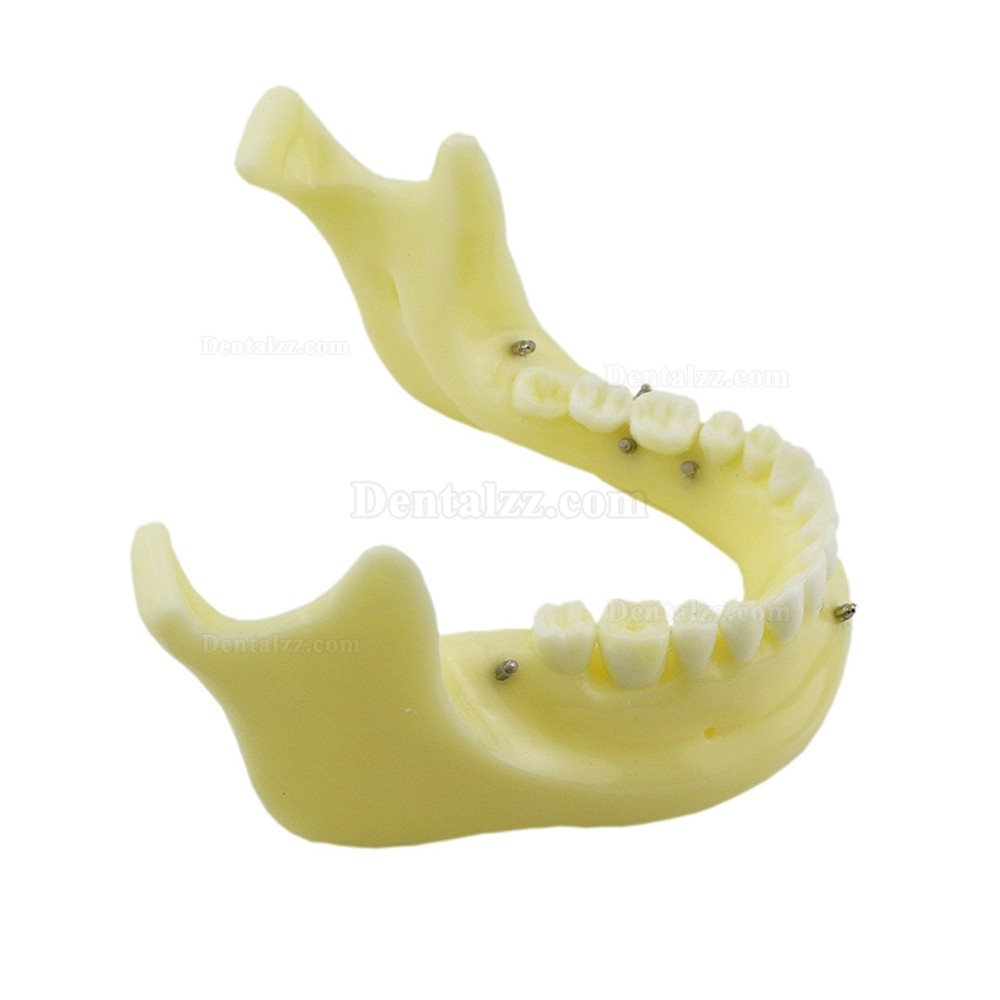歯科矯正用上下顎歯列模型モデル スクリューアンカー付き 脱着可能 イエローベース