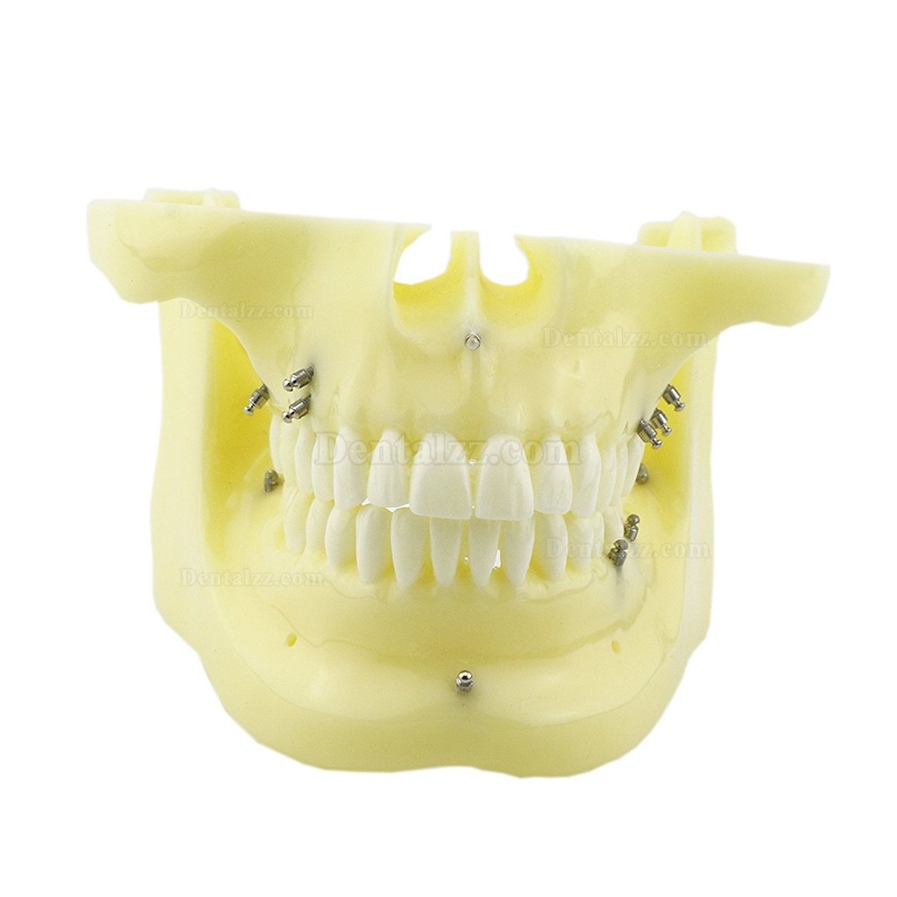 歯科矯正用上下顎歯列模型モデル スクリューアンカー付き 脱着可能 イエローベース