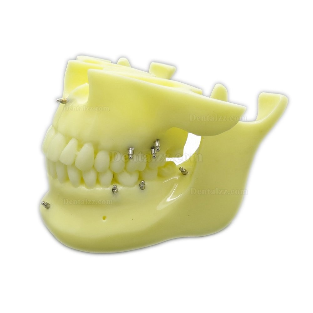 歯科矯正用上下顎歯列模型モデル スクリューアンカー付き 脱着可能 イエローベース